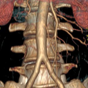 Abdominalarterien CT-Angiographie o.B. Abdominalarterien CT-Angiographie o.B.