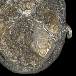 Arachnoidalzyste des Kleinhirnbrückenwinkels MRT-T2W-Dünnschicht-VR Arachnoidalzyste des Kleinhirnbrückenwinkels MRT-T2W-Dünnschicht-VR