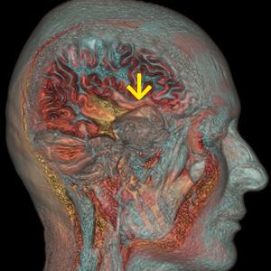 Astrozytomrezidiv Temprallappenepilepsie MRT-VR Astrozytomrezidiv Temprallappenepilepsie MRT-VR