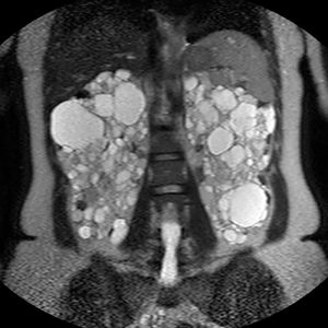 Autosomal dominante Polyzystische Nierenerkrankung MRT-T2W-cor