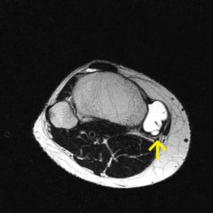 Bursitis des pes anserinus MRT-T2W-axial Bursitis des pes anserinus MRT-T2W-axial
