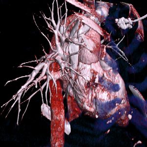 CTA Lungengefäße nach Lungenarterienembolie CTA Lungengefäße nach Lungenarterienembolie