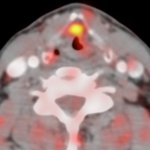 CUP Plattenepithelkarzinom Larynx FDG-PET/CT