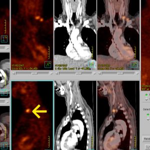 CUP Syndrom Urothelcarcinom Virchow Lymphknotenmetastase FDG-PET/CT CUP Syndrom Urothelcarcinom Virchow Lymphknotenmetastase FDG-PET/CT