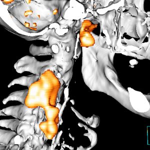 CUP Plattenepithelcarcinom Nasopharynx mit Lymphknotenmetastasen FDG-PET/CT CUP Plattenepithelcarcinom Nasopharynx mit Lymphknotenmetastasen FDG-PET/CT