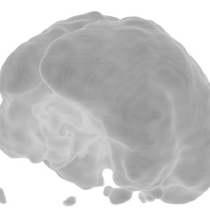 Cerebellärer Hypometabolismus PICA-Direktabgang FDG-PET-VR Cerebellärer Hypometabolismus PICA-Direktabgang FDG-PET-VR