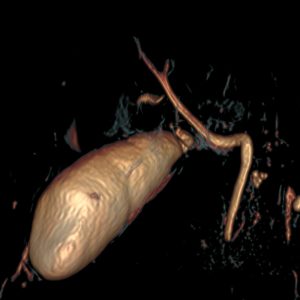 Cholangitis Amputation intrahepat Verzweigungen MRCP Cholangitis Amputation intrahepat Verzweigungen MRCP