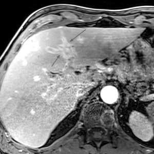 Cholangitis MRT-T1 mit KM Cholangitis MRT-T1 mit KM