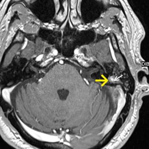 Cholesteringranulom linkes Mittelohr MRT-T1KM