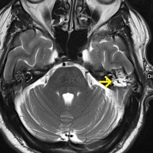 Cholesteringranulom links MRT-axiale-T2W