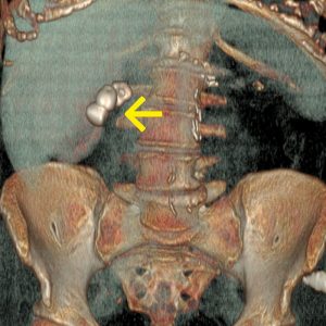 Cholezystolithiasis CT-VR Cholezystolithiasis CT-VR