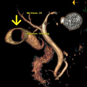 Cholezystolithiasis Solitärkonkrement MRCP-VR Cholezystolithiasis Solitärkonkrement MRCP-VR