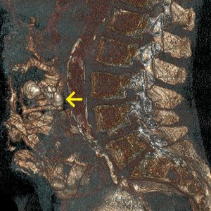 Diffus grosszelliges Lymphom / verkalkter Rest nach Chemotherapie CT-VR Diffus grosszelliges Lymphom / verkalkter Rest nach Chemotherapie CT-VR