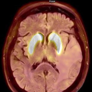 F-DOPA PET-MRT Normalbefund F-DOPA PET-MRT Normalbefund