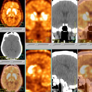 F-DOPA PET/CT Normalbefund F-DOPA PET/CT Normalbefund