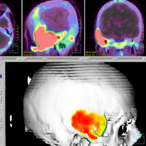 Fibröse Dysplasie dd-M-Paget-F18-Fluorid-PET/CT