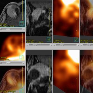 Follikuläres Non-Hodgkin-Lymphom der Glandula lacrimalis FDG-PET/CT
