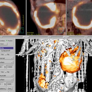 GIST Gastrointestinaler Stromatumor FDG-PET/CT GIST Gastrointestinaler Stromatumor FDG-PET/CT