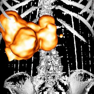 Gallenwegscarcinom FDG-PET/CT Gallenwegscarcinom FDG-PET/CT