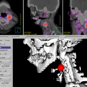 Glomus caroticum Tumor Ga68-DOTATOC-PET/CT Glomus caroticum Tumor Ga68-DOTATOC-PET/CT