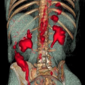 Großgefäßvaskulitis der Aorta FDG-PET/CT Großgefäßvaskulitis der Aorta FDG-PET/CT