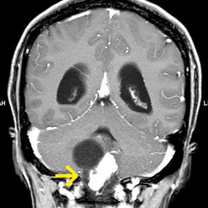 Haemangioblastom-cyst-and-mural-nodule-MRT-T1W-mit-KM-coronar Haemangioblastom-cyst-and-mural-nodule-MRT-T1W-mit-KM-coronar
