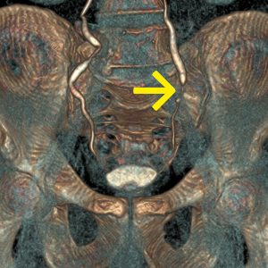 Harnleitertumor li CT-Urographie Mikrohaematurie