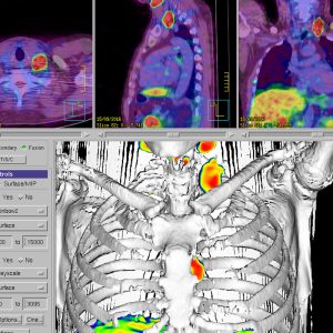 Hochrisikoprostatacarcinom Gleason 4+5=9 / iPSA 11 ng_ml Virchow LK Metastase Ga68- PSMA PET/CT Hochrisikoprostatacarcinom Gleason 4+5=9 / iPSA 11 ng_ml Virchow LK Metastase Ga68- PSMA PET/CT