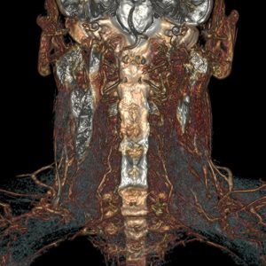 Hypopharynxcarcinom rechts Lymphknotenmetastasen MRT-Volumenrekonstruktion Hypopharynxcarcinom rechts Lymphknotenmetastasen MRT-Volumenrekonstruktion