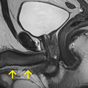 Hypospadie Neourethra mit Mundschleimhaut MRT-sag-T2W