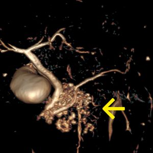 IPMN Intraduktale papillär-muzinöse Neoplasie Processus uncinatus MRCP-VR IPMN Intraduktale papillär-muzinöse Neoplasie Processus uncinatus MRCP-VR