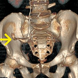 Ileumconduit nach HarnblasenCa CT-Urographie