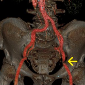 Iliakalarterienstenose links Fontaine II CT-Angio Iliakalarterienstenose links Fontaine II CT-Angio