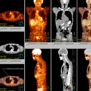 Infizierter Katheterspitzenthrombus FDG-PET/CT Infizierter Katheterspitzenthrombus FDG-PET/CT