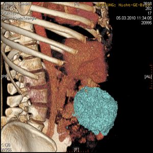 Intraabdominelles Desmoid CT-VR Intraabdominelles Desmoid CT-VR