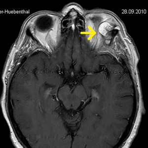 Intraorbitales Dermoid Doppelbilder MRT-T1W mit KM