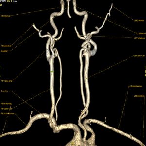 KM-gestuetzte-MR-Angiographie-extrakranielle-hirnversorgende-Arterien KM-gestuetzte-MR-Angiographie-extrakranielle-hirnversorgende-Arterien