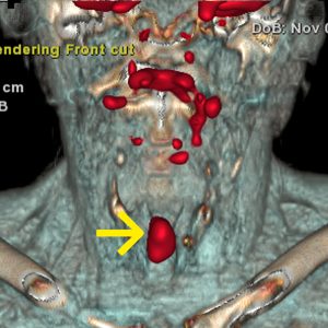 Kehlkopfkrebs FDG-PET/CT
