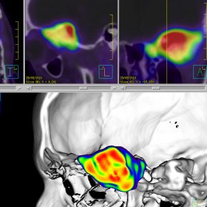 Keilbeinmeningeom links Ga68-DOTATOC-PET/CT