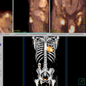 LK Konglomerate bei Neurodermitis CEA Erhoehung FDG-PET/CT LK Konglomerate bei Neurodermitis CEA Erhoehung FDG-PET/CT
