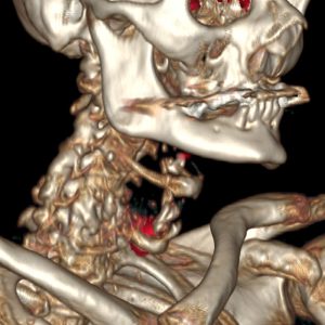 Larynx CA