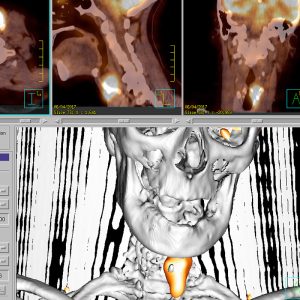 Larynxkarzinom Kehlkopfkrebs FDG-PET/CT