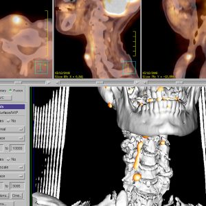 Larynxkarzinom Rezidiv FDG-PET/CT