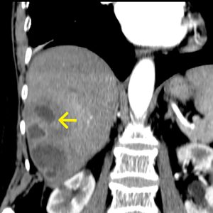 Leberabszess CT mit KM coronar Leberabszess CT mit KM coronar
