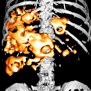 Lebermetastasen FDG-PET/CT Lebermetastasen FDG-PET/CT