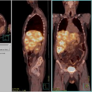 Lebermetastasen FDG-PET/CT Lebermetastasen FDG-PET/CT