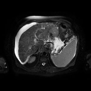 Leberzirrhose hepatozelluläres Karzinom HCC-dd Regeneratknoten Leberzirrhose hepatozelluläres Karzinom HCC-dd Regeneratknoten