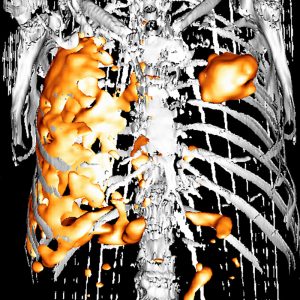 Lungenkrebs und Pleuramesotheliomv FDG-PET/CT Lungenkrebs und Pleuramesotheliomv FDG-PET/CT