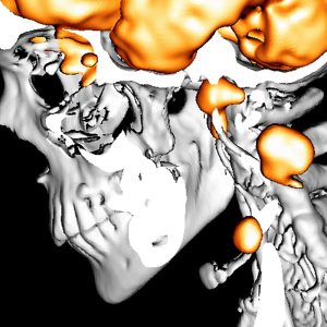 Lymphogen metastasiertes Plattenepithelkarzinom des Nasopharynx FDG-PET/CT