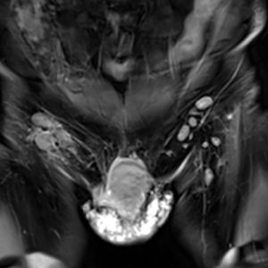 Lymphom rechte Leiste MRT Lymphom rechte Leiste MRT
